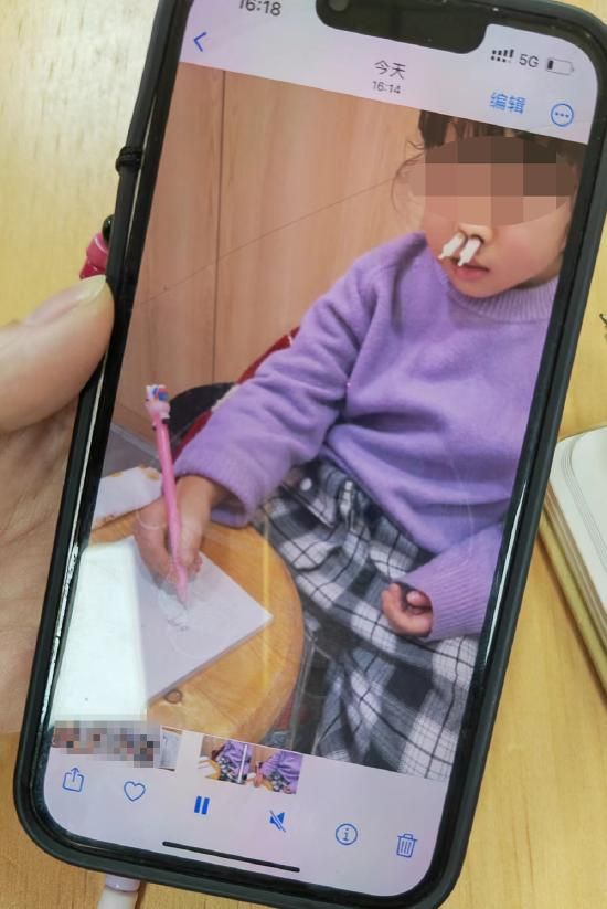 接受消鼻甲治疗的孩子