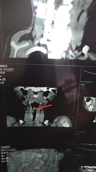 4月7日,星元医院CT结果显示,软管目前位于小白颈部左侧腮腺内。 本版图片/受访者供图