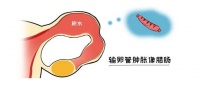 输卵管积水，怎样才能更快怀孕？