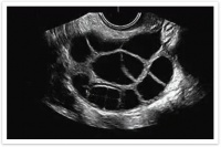 读懂超声卵泡监测，抓住备孕黄金期