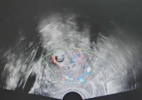 凶险宫角妊娠暗藏危机 微创精准施治化险为夷