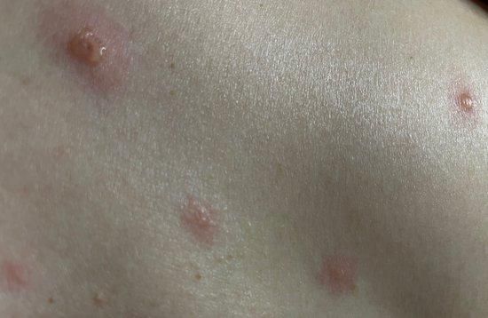 水痘。受访者供图