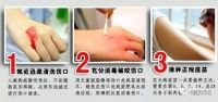 狂犬病致死率100% 收藏急救处理小知识