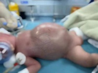 新生儿腹大如鼓!多亏这群普陀医生救回一命……