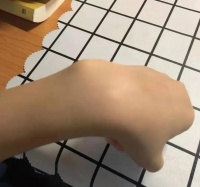 宝妈肌腱炎+滑膜炎同时发作!还好有医生指导,针灸配合膏药30天全好了!