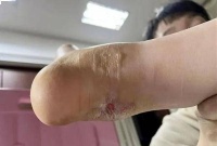 男孩突然脚肿成“猪蹄”,竟是因为大冬天被蚊子咬了一口