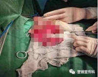 【妙手回春】险象丛生,菏泽市立医院专家多学科配合,救治危重早产儿