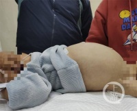 1岁幼儿误食水宝宝肚子胀得像气球 医生:这些玩具容易误食
