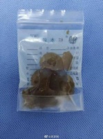 1岁男童误吞水宝宝腹胀如鼓 医生提醒家长要注意