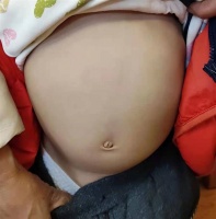 宝宝“青蛙肚”太大,送医发现巨大肿瘤,专家:腹部肿瘤可通过洗澡摸肚子发现