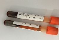 孕期可以随便吃?小心高脂血症性急性胰腺炎!