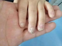 家有小孩注意了!!别让灰指甲传染给孩子,真菌发作指甲丑陋不堪后悔莫及!