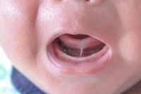 原创 宝宝“舌筋短”,到底要不要剪?最佳处理时间是几岁?