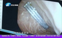 1岁婴儿胃内发现3根6cm长钢钉!这些潜在的危险家长朋友们千万别大意