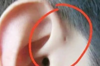 原创 孩子耳朵有一个小孔?不是老人说的“有福气”!爸妈一定要注意