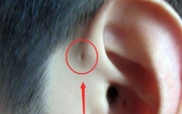 原创 孩子生下来耳朵上就有小孔?不是福气!爸妈要心里有数,不容忽视