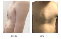 家长注意!小孩“鸡胸”或影响心肺!