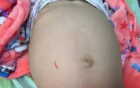 原创 3岁孩子肚子鼓起,医生竟从中抽取1800ml脓液!家长要当心