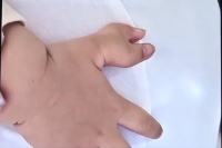 孩子出生后,爸妈差点崩溃:他怎么长着一只“蟹钳”?