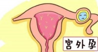 原创             常见的宫外孕为“输卵管妊娠”，除了这种，还有3种不常见情况