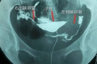 输卵管检查每个人都有必要做吗？检查该注意啥？