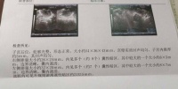 患了多囊卵巢很难再怀孕,有没有好的解决方式