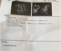 年纪轻轻就得了多囊，导致结婚后长久不孕，中医调理帮了大忙