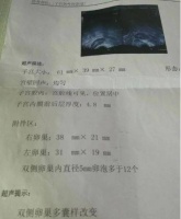 多囊引起不孕，刚开始相信大医院，后来还是靠中医调理好了