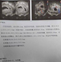 婚后不孕竟患多囊,中医调理喜获双胞胎宝宝!