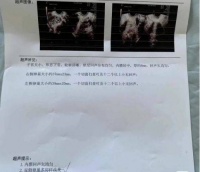 多囊卵巢综合征导致不孕,中医调理后自然怀孕