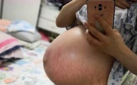 试管婴儿能提高双胞胎概率?多胎妊娠有隐藏风险,会受年龄限制