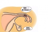 为什么输卵管容易发生宫外孕?宫外孕过还能正常怀孕吗?