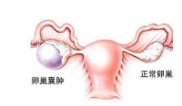 原创 这些身体的变化是卵巢囊肿的症状,有几个原因要重视