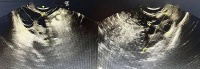 【中医妇科】好消息!北京中医药大学东方医院多囊卵巢综合征专病门诊开诊啦!