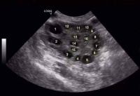 「多囊卵巢」影响怀孕,这几类女性要注意