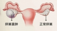 卵巢囊肿不能视而不见，要及时破瘀补虚