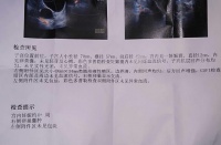 一分钟教你看懂卵巢囊肿报告单