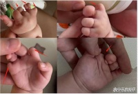 原创 试管婴儿7个手指畸形,20多次产检未发现,家属质疑宜春妇保漏诊