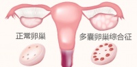 怀不上,身材胖,亲戚出走?因为多囊备孕走投无路的姐妹看过来