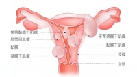 同样是子宫肌瘤,为什么有的会造成不孕?!