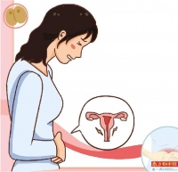 不孕真凶不是痛经 是子宫内膜异位症