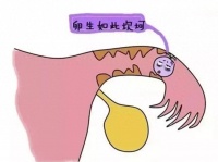 生命之路“输卵管”堵住了怎么办?这些治疗助你“打通”好孕通道