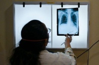 世卫报告:2022年全球130万人死于结核病相关疾病
