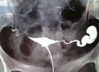原创 输卵管积水必须切输卵管吗?