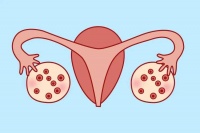 红睦房祝秀英医生:多囊女性备孕要注意这几点
