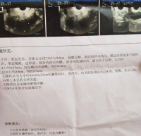 【真实案例】多发肌瘤+卵巢囊肿,应该如何治疗?