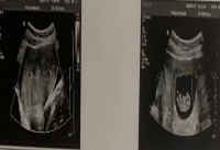 女子晚婚求子却遭不孕,如今的她终于收获了期待已久的“惊喜”