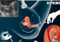 原创 试管婴儿初夏腹水应该怎么办