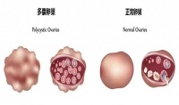 月经不规律,受孕困难,警惕多囊卵巢综合征!