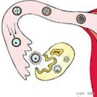 总不怀孕,发现输卵管异常怎么办?